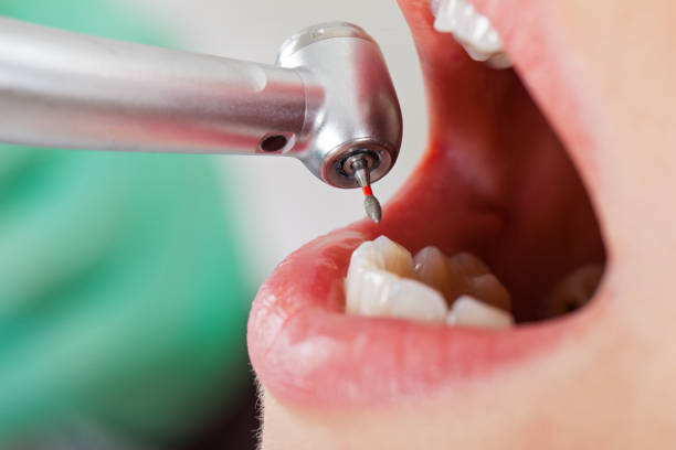 Best Emergency Dental Care for Abscessed Tooth in Mclean, TX
